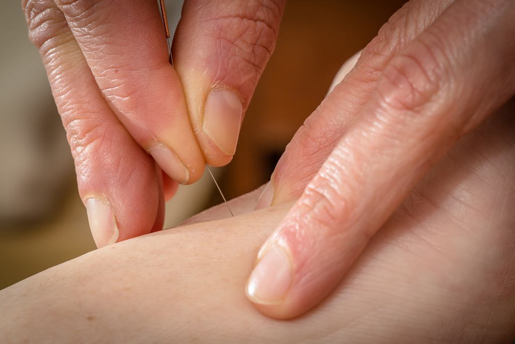 L’acupuncture et ses effets sur la santé