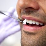Facettes dentaires : les professionnels vous parlent de cette technique pour avoir un sourire parfait !