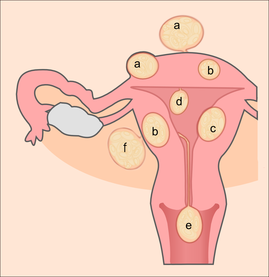 Le cancer des ovaires : une maladie dégénérative bien redoutée