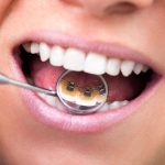 Comment fonctionne un appareil dentaire lingual ?