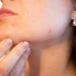 Comment traiter l’acné ?