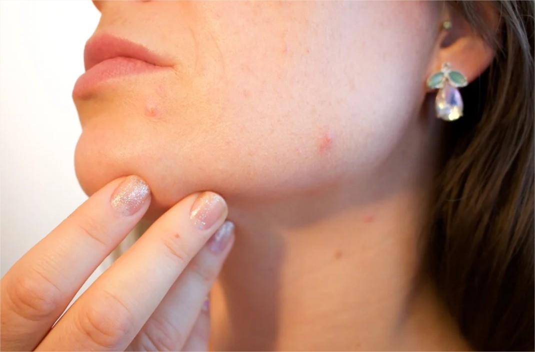 Que recommandent les dermatologues face aux problèmes d’acné ?