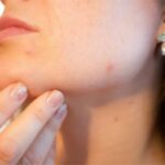 Que recommandent les dermatologues face aux problèmes d’acné ?