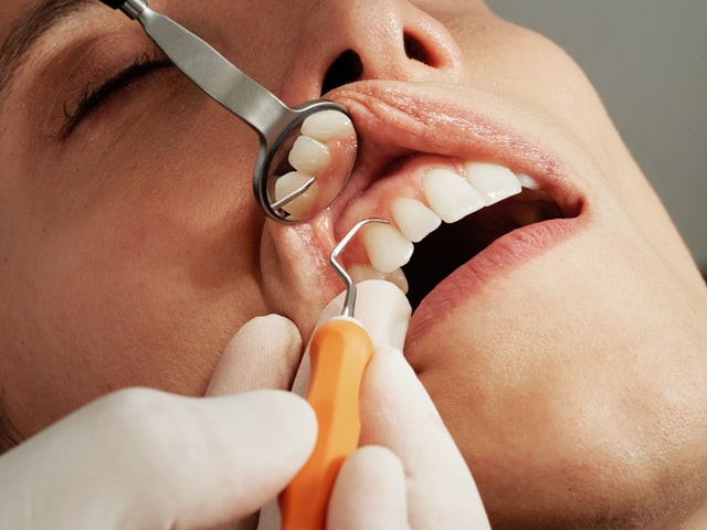 Mutuelle dentaire : combien cela coûte pour être bien remboursé ?