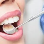 Le tartre dentaire noir : origines, conséquences et prévention